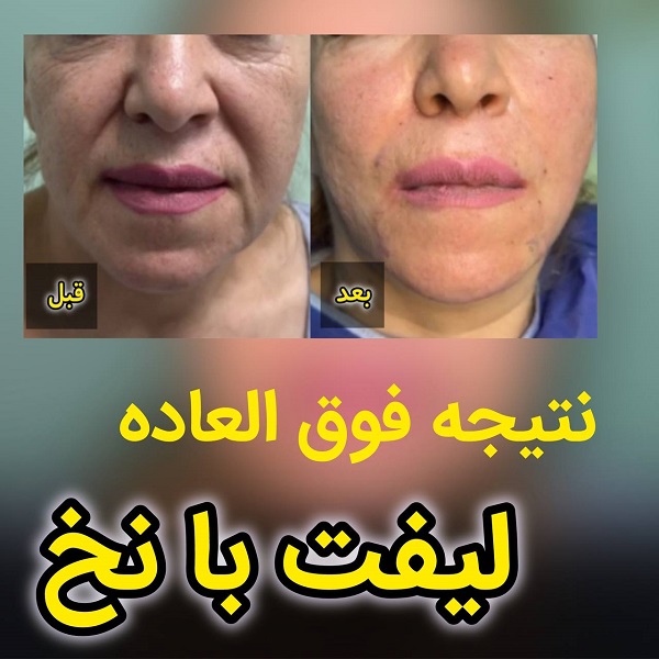 نمون لیفت صورت با نخ در کلینیک اورانوس