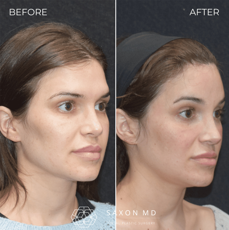 اقدامات و مراقبت های لازم پس از جراحی پیشانی ناندرتال