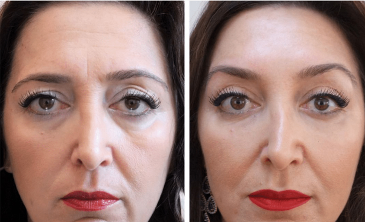 مزایای لیفت ابرو