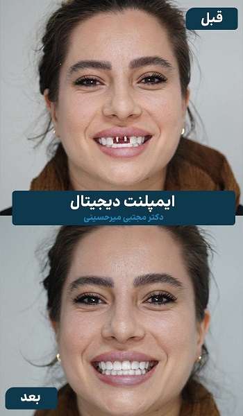 نمونه ایمپلنت دندان در دندانپزشکی هومینا