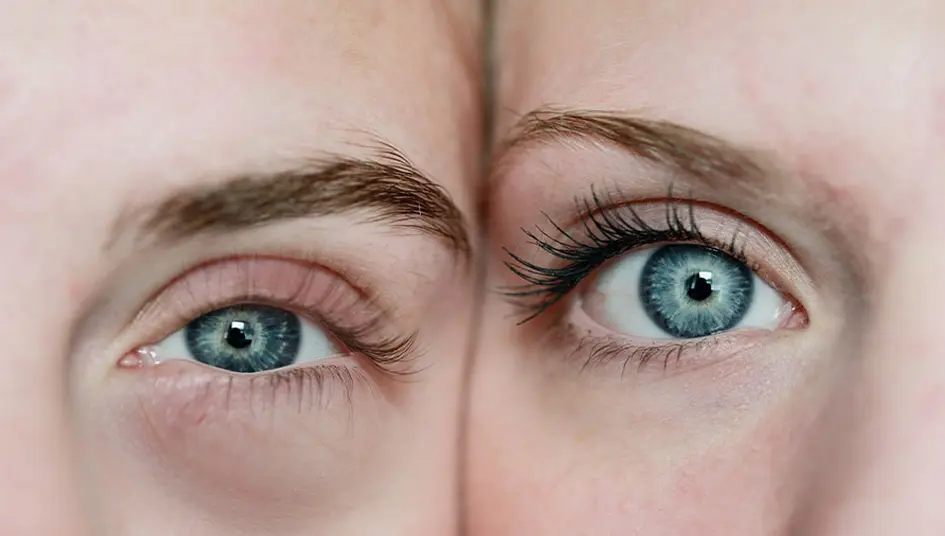 علت به وجود آمدن پف چشم چیست؟