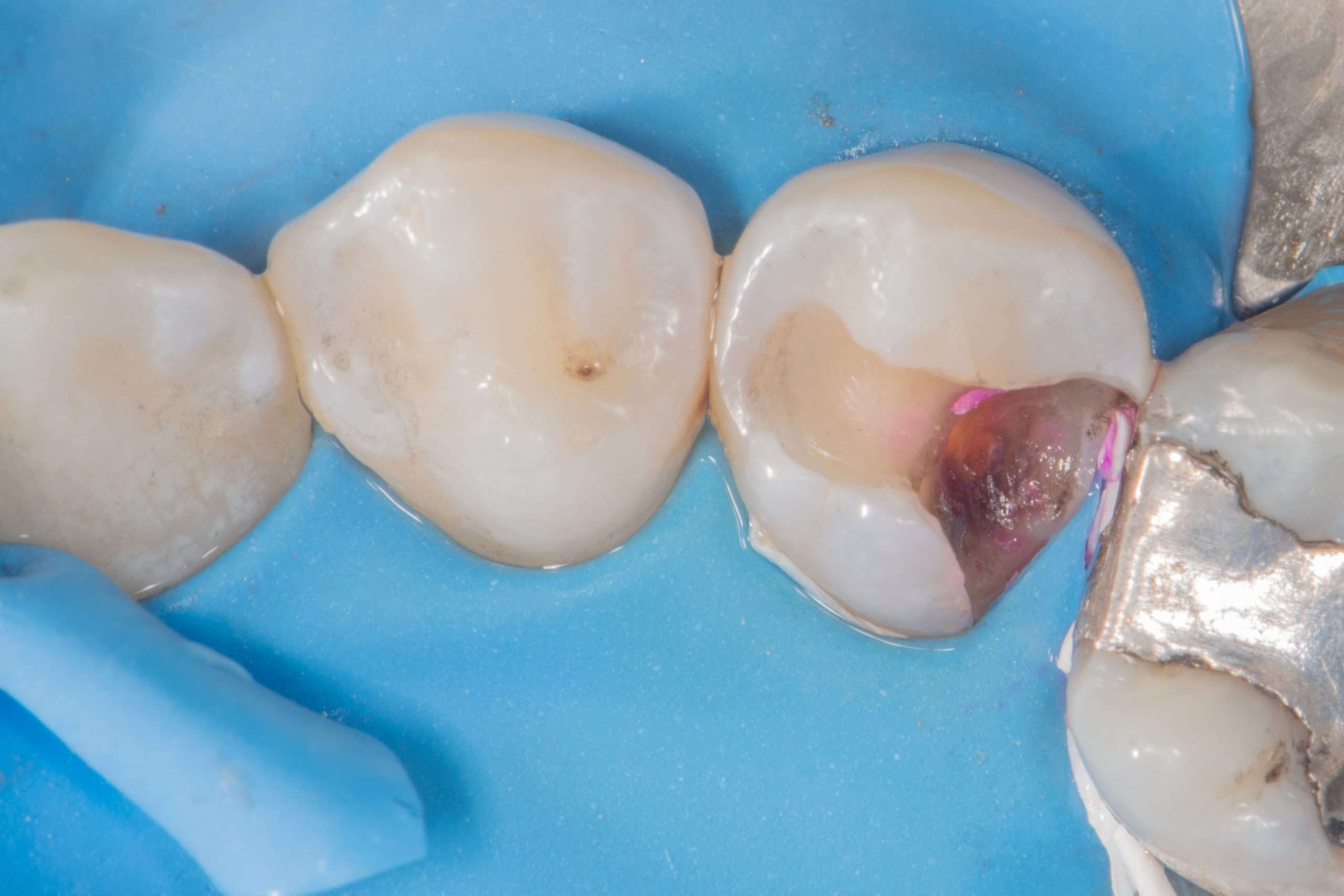 برتری های دندانپزشکی بیومیمتیک