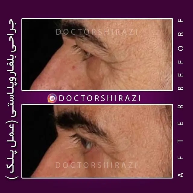 نمونه قبل و بعد از بلفاروپلاستی دکتر علی اصغر شیرازی