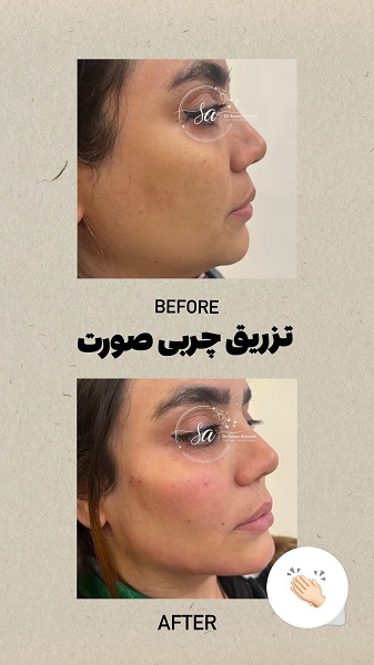 نمونه تزریق چربی - دکتر سوسن احمدی