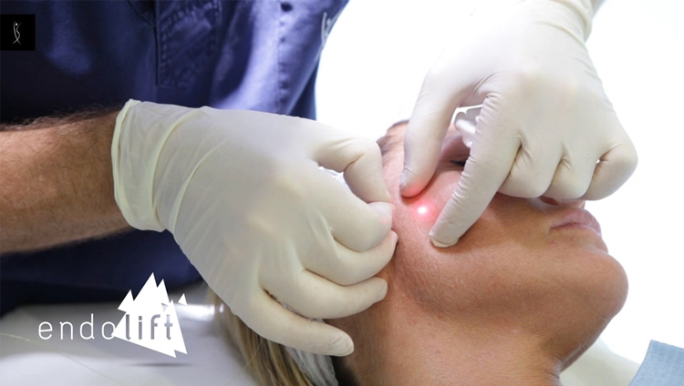 اندولیفت در چه مواردی کاربرد دارد؟