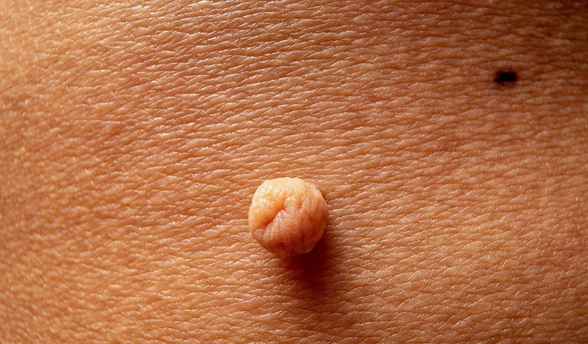 ویژگی های خال گوشتی