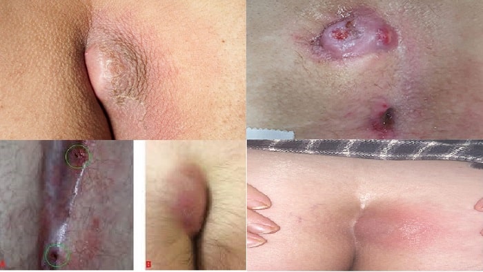 pilonidal-cyst-Abcess-min