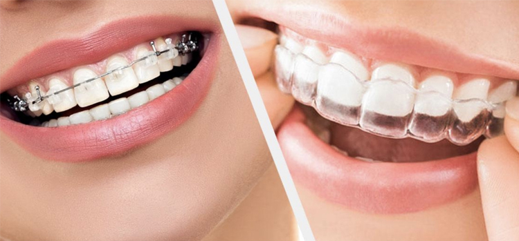 ارتودنسی اقساطی در تهران چه مزایایی دارد؟