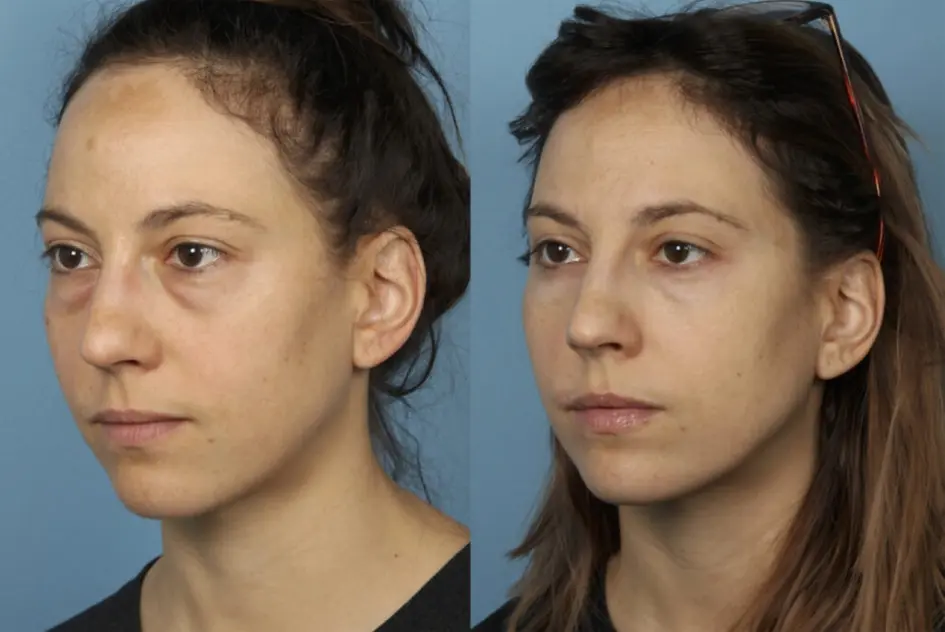 بلفاروپلاستی