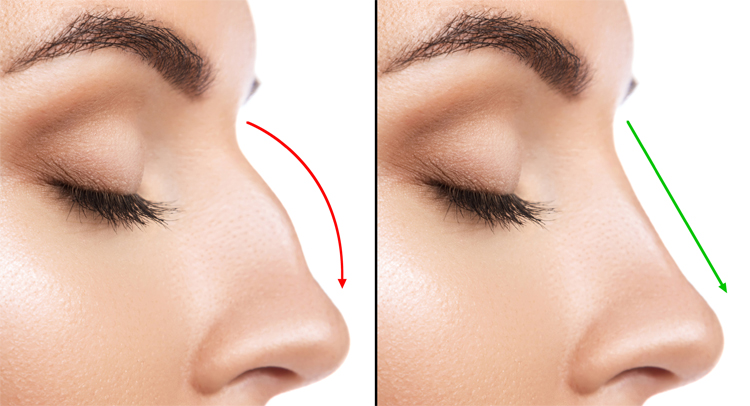 عمل بینی بدون بیهوشی امکان پذیر است؟