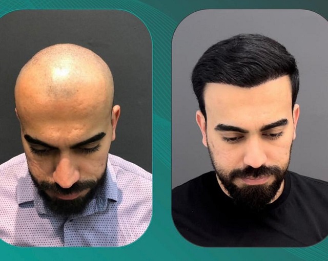 نمونه کاشت مو - کلینیک پارسیان