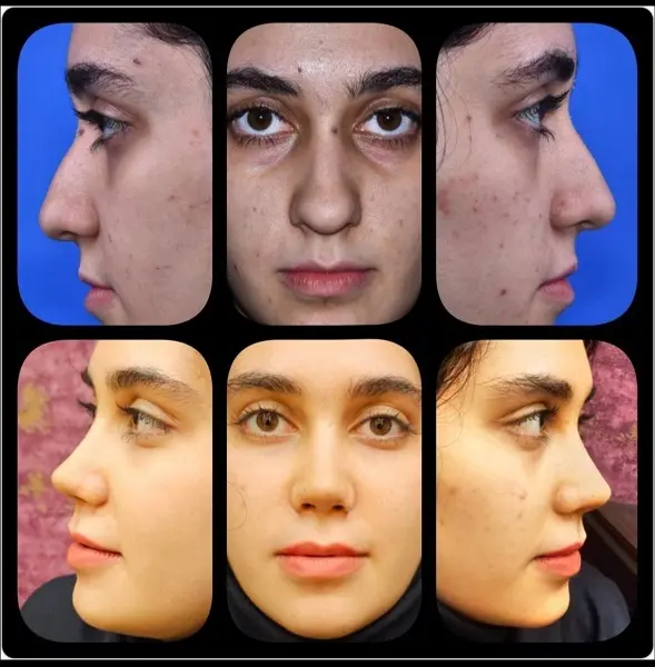 نمونه جراحی بینی دکتر سعید رجبیان