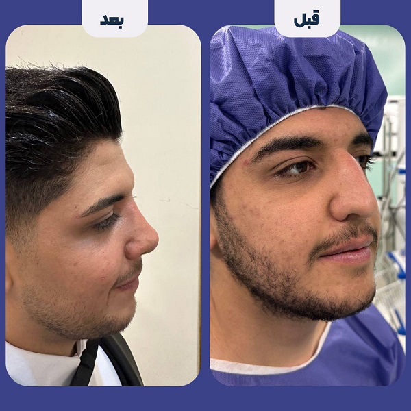 نمونه جراحی بینی دکتر محمد لاجوردی