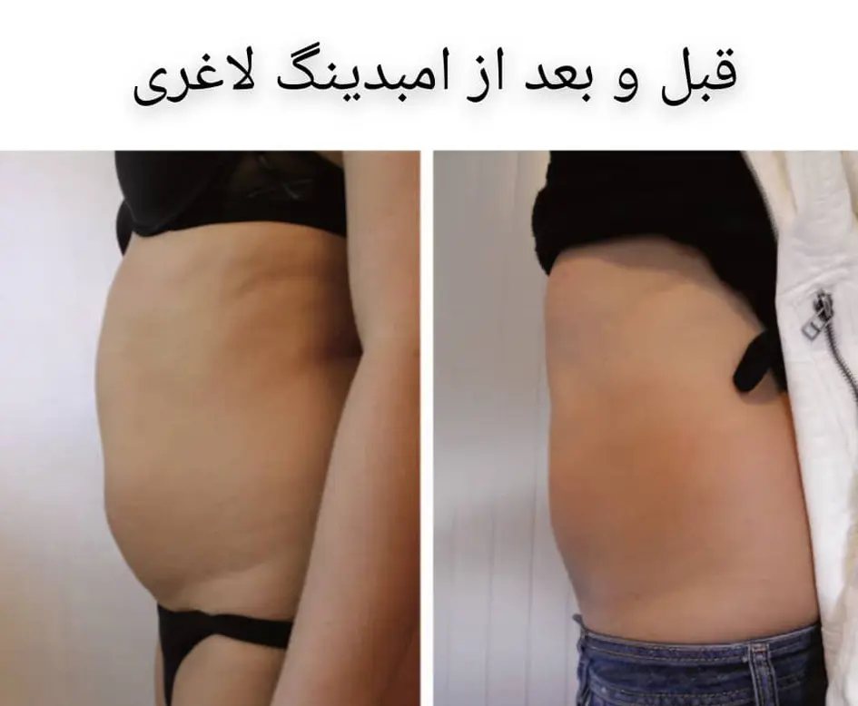 مزایای روش امبدینگ یا لاغری با نخ چیست؟