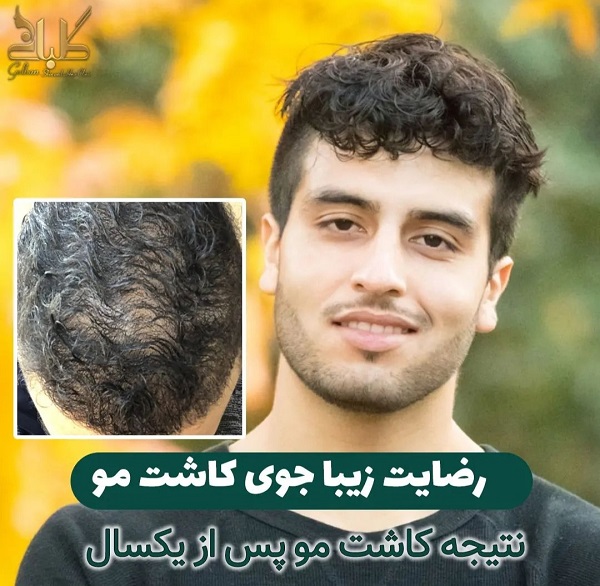 لیست 10 مورد از بهترین کلینیک های کاشت مو در تهران