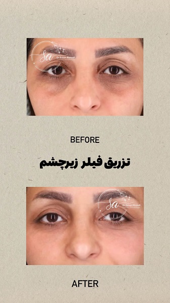 نمونه تزریق مزوژل - دکتر سوسن احمدی
