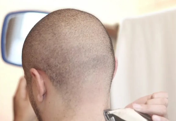 هزینه کاشت مو 
