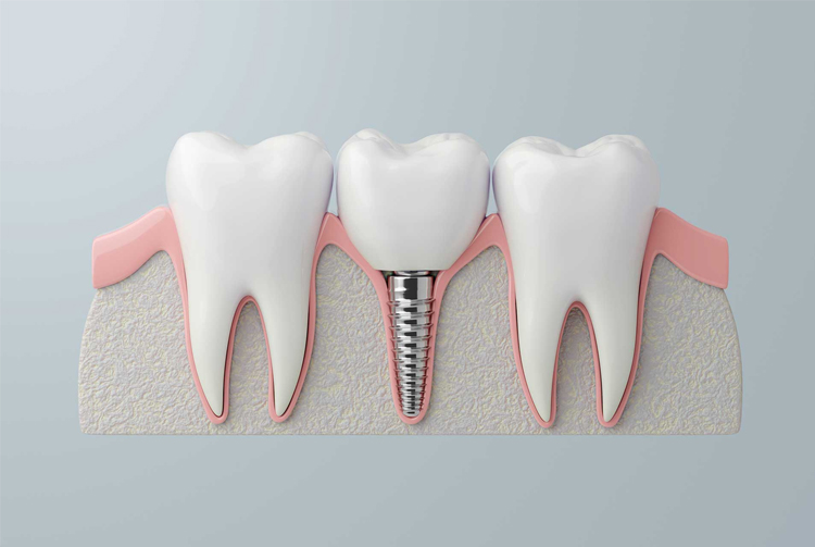 بهترین مرکز ایمپلنت در کرج چه ویژگی‌هایی دارد؟