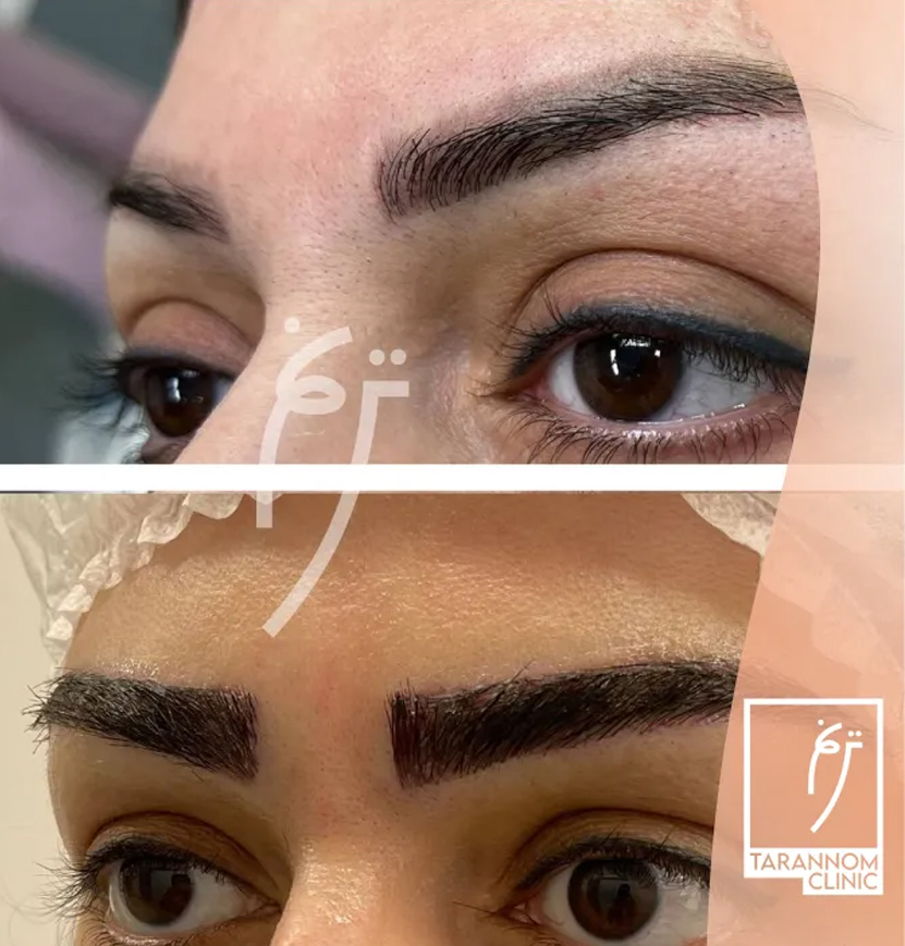 ویژگی های کلینیک کاشت ابرو ترنم
