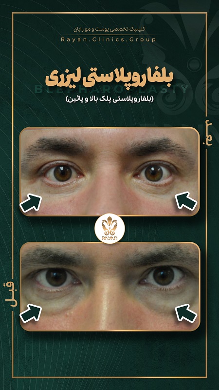 Story Before After Belfa 5