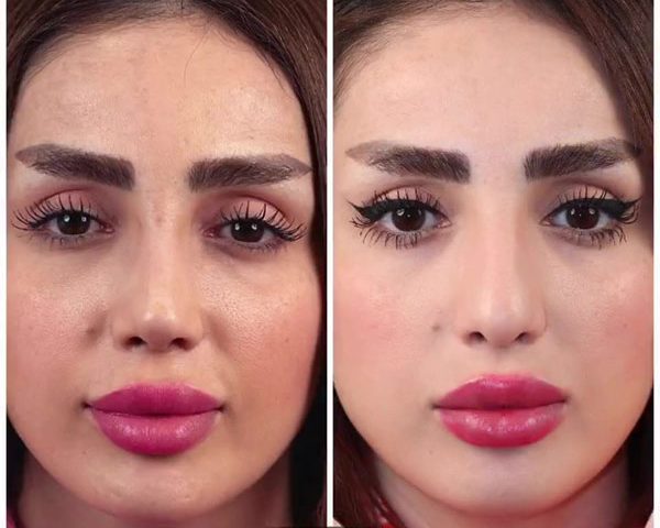 تفاوت عمل طبیعی با عمل بینی عروسکی یا فانتزی در چیست؟