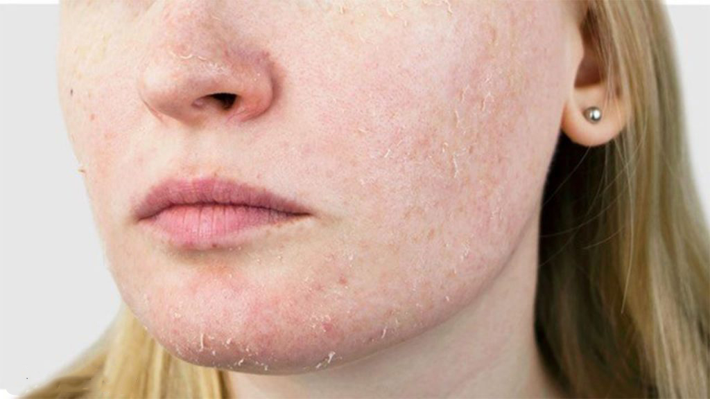 Dry-skin-winter-1024x576
