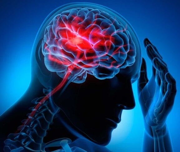 علایم و نشانه‌های سکته مغزی را بشناسید