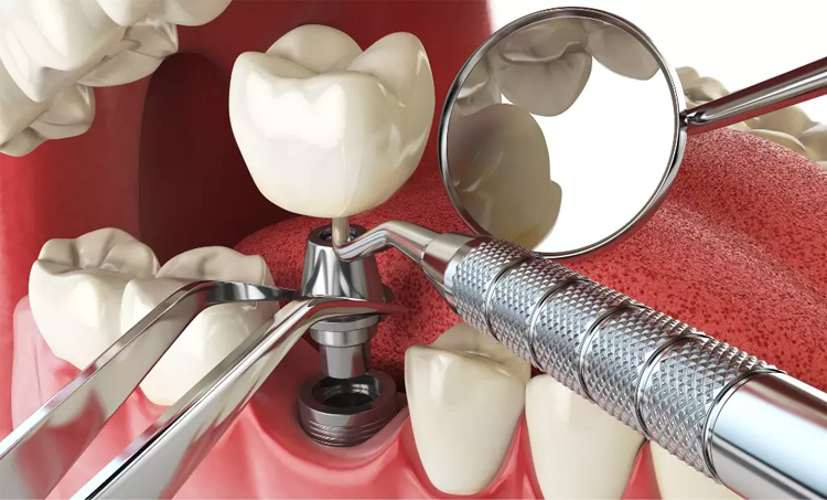 بهترین مرکز تخصصی ایمپلنت در کرج + لیست 10 مرکز برتر