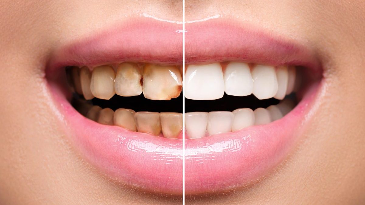 Que-es-un-composite-dental