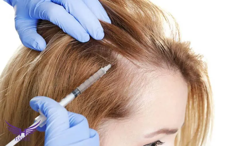 پی-آر-پی-مو-کلینیک-زیبایی-هانیل-min