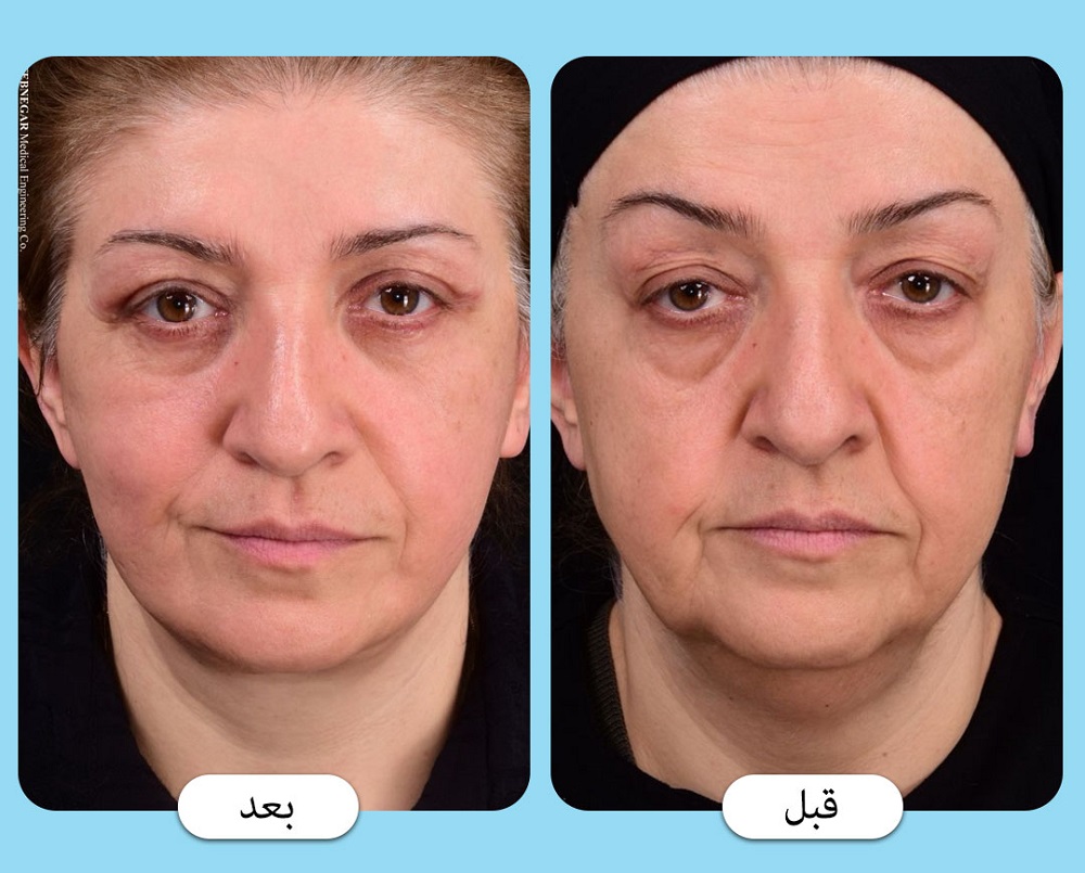 نمونه قبل و بعد از جراحی لیفت صورت - دکتر دریانی