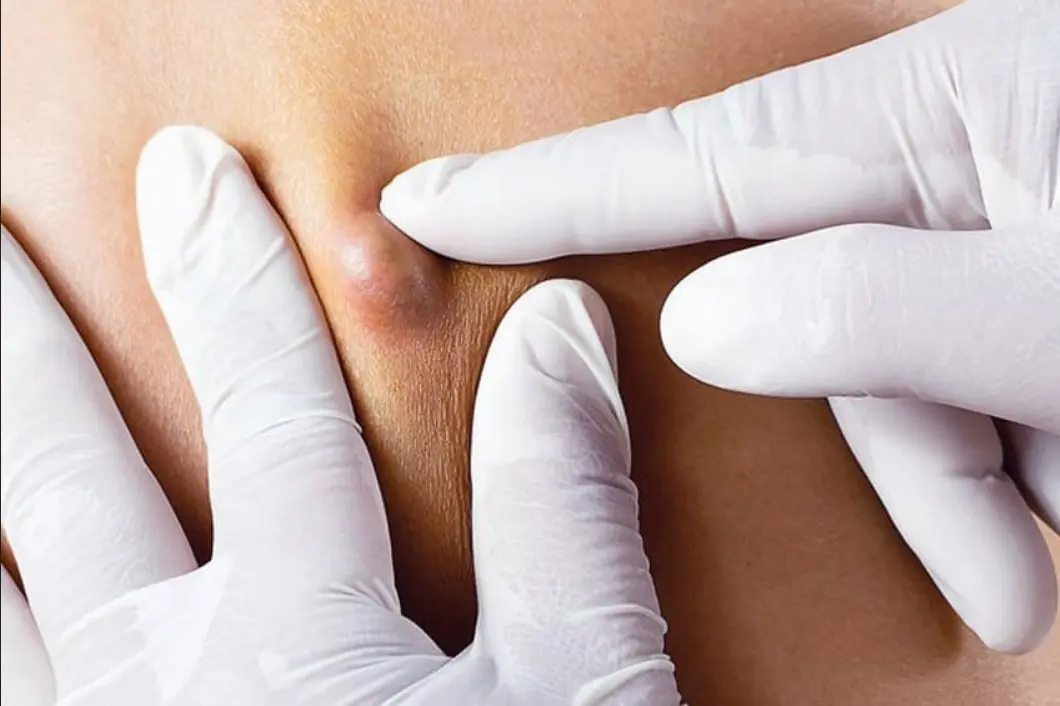 Screenshot 2026-05-11 at 13-20-58 cyst-removal-Cyst-Removal-1.jpg (JPEG Image 848 × 565 pixels)
