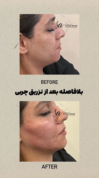 نمونه تزریق چربی - دکتر سوسن احمدی