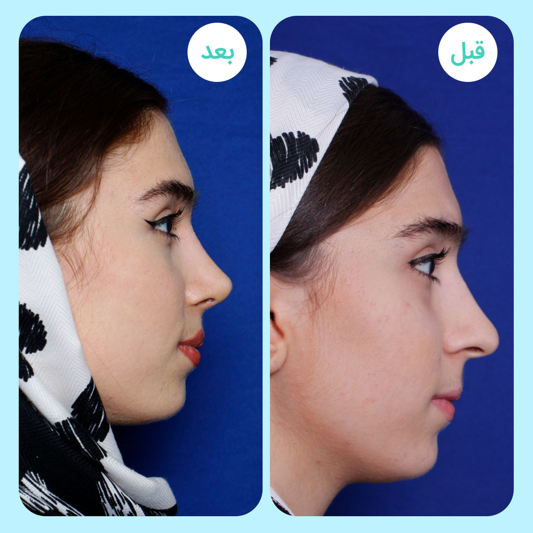 نمونه جراحی بینی دکتر لیلا نوری
