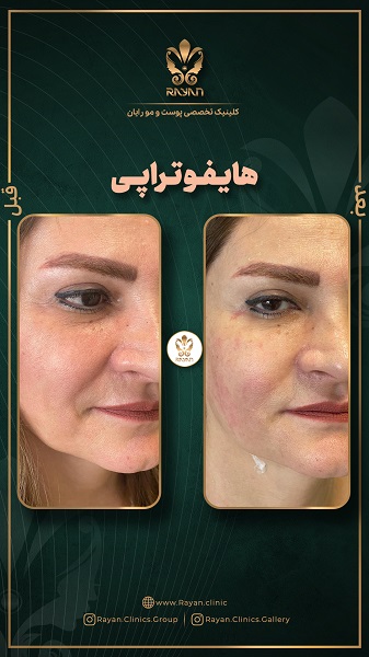 هایفوتراپی صورت - کلینیک رایان سلامت