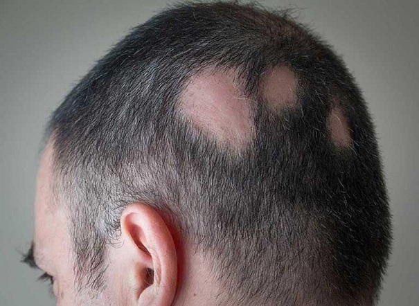 مزوتراپی مو چیست و چگونه برای درمان ریزش مو استفاده می‌شود؟
