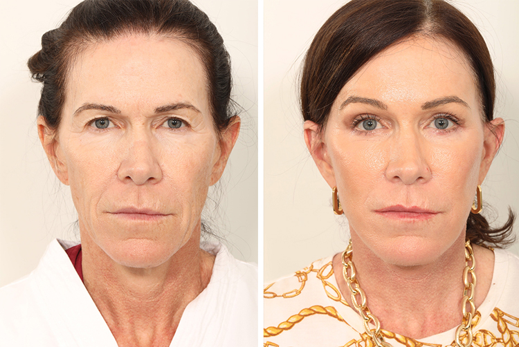 لیفت اندوسکوپیک ابرو 