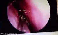 خارج کردن یک سوسک زنده از درون جمجمه زن ۴۲ ساله