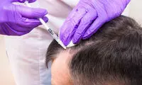 فیلر مو (هیر فیلر) چیست؟ کاربرد، ماندگاری،‌ عوارض و مزایا