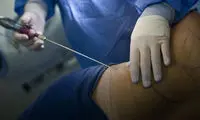 هزینه عمل لیپوساکشن شکم و پهلو در سال 1404 چقدر است؟