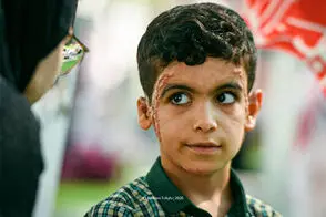 تصویری تلخ از آثار بمباران روی صورت دانش‌آموز مینابی