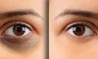 روش خانگی از بین بردن تیرگی دور چشم