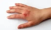 5توصیه برای بهبود «زخم»