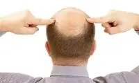 خبر خوب برای کسانی که طاسی دارند