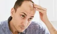 چند باور نادرست درباره ریزش مو