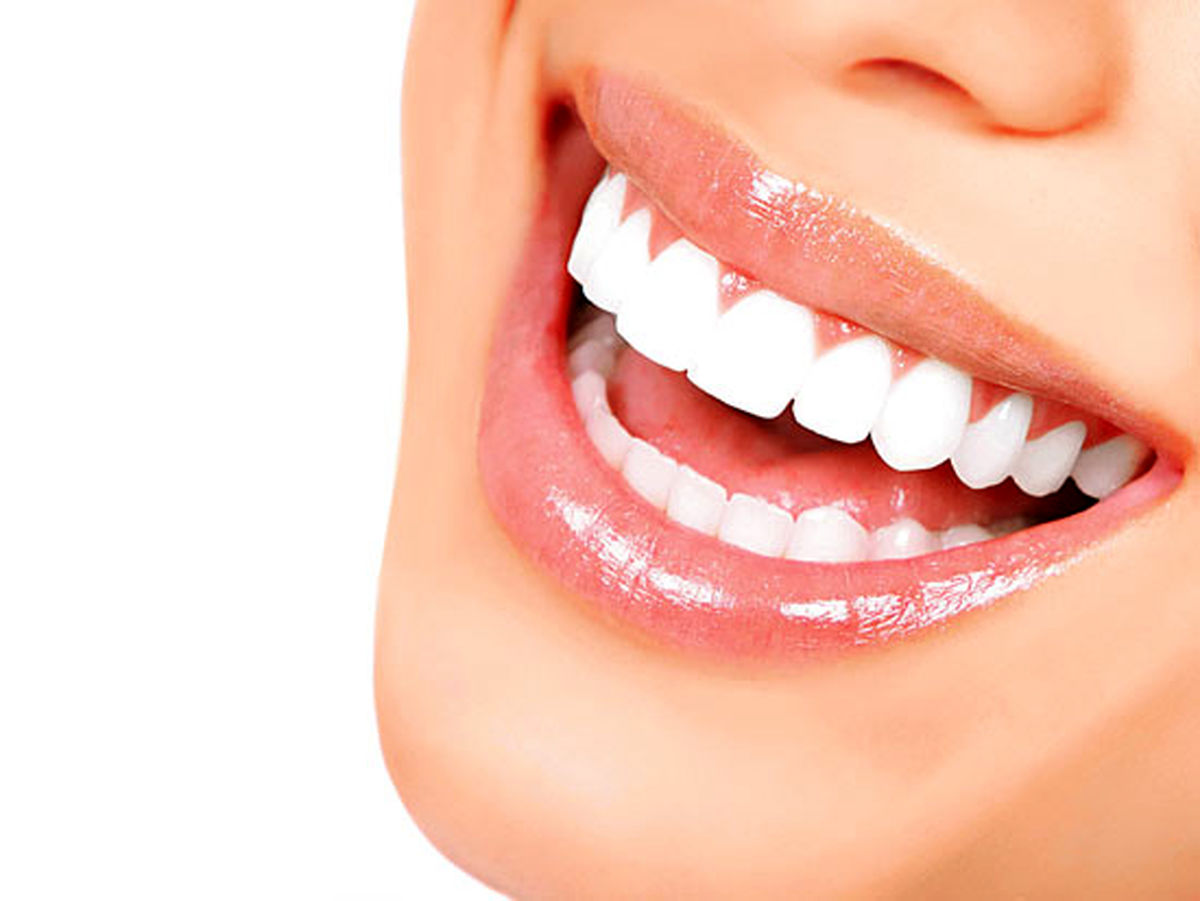   روکش دندان و لمینت چه تفاوتی باهم دارند؟ 