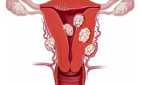 بهترین روش درمان فیبروم رحم چیست؟