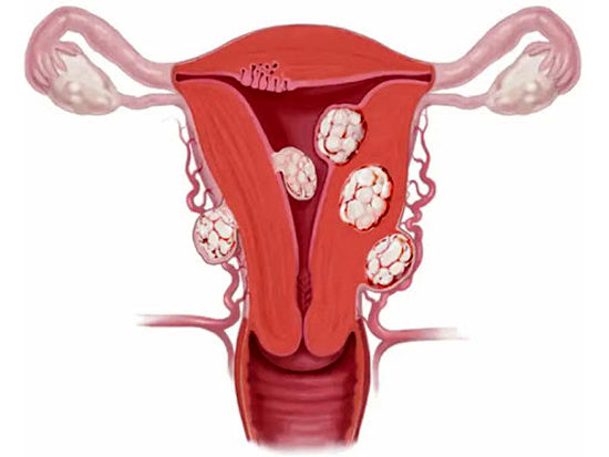بهترین روش درمان فیبروم رحم چیست؟