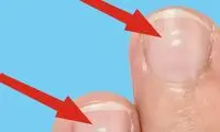 لکه‌های سفید روی ناخن‌ها چه معنایی دارند؟