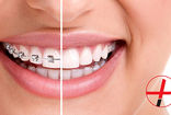 ارتودنسی بهتر است یا کامپوزیت